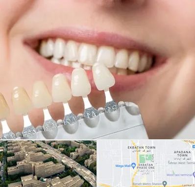 مرکز کامپوزیت دندان در اکباتان