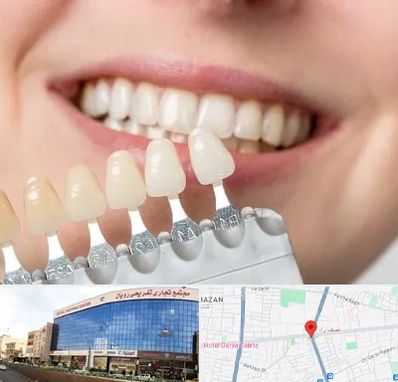 مرکز کامپوزیت دندان در نصف راه تبریز