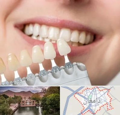مرکز کامپوزیت دندان در دامغان