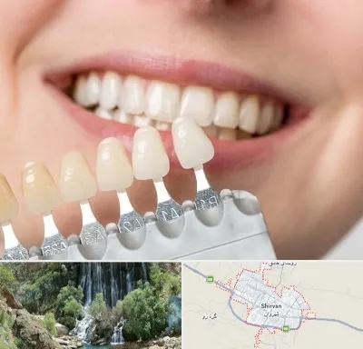 مرکز کامپوزیت دندان در شیروان