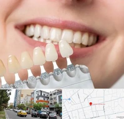 مرکز کامپوزیت دندان در هفده شهریور تبریز