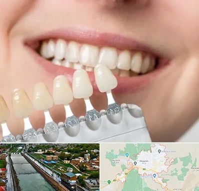 مرکز کامپوزیت دندان در مراغه