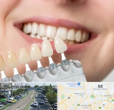 مرکز کامپوزیت دندان در جنوب تهران