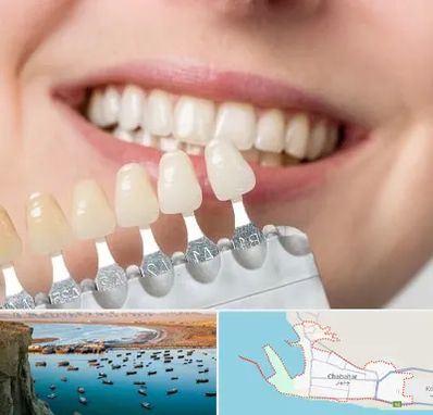 مرکز کامپوزیت دندان در چابهار