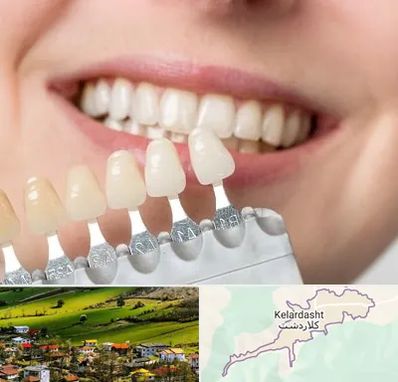 مرکز کامپوزیت دندان در کلاردشت