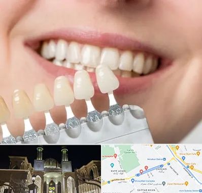 مرکز کامپوزیت دندان در زرگری شیراز