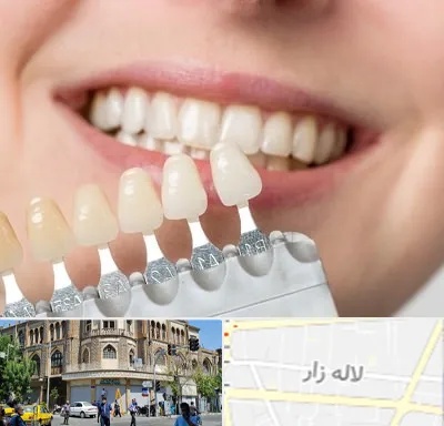 مرکز کامپوزیت دندان در لاله زار