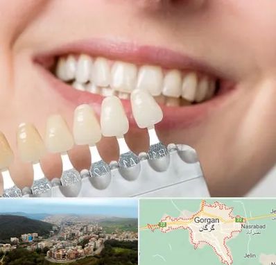 مرکز کامپوزیت دندان در گرگان