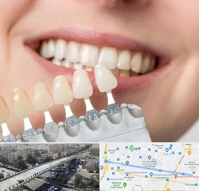 مرکز کامپوزیت دندان در فرجام