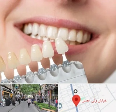 مرکز کامپوزیت دندان در ولیعصر شهریار
