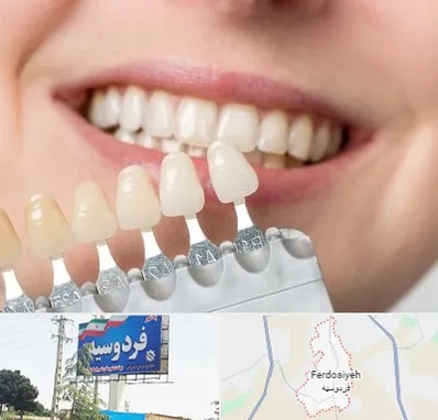 مرکز کامپوزیت دندان در فردوسیه شهریار