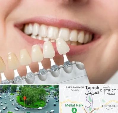 مرکز کامپوزیت دندان در تجریش