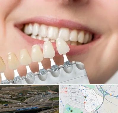 مرکز کامپوزیت دندان در یاغچیان تبریز