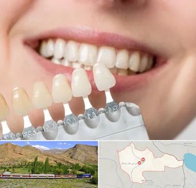 مرکز کامپوزیت دندان در خاش