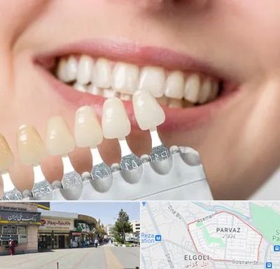 مرکز کامپوزیت دندان در پرواز تبریز