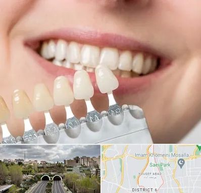 مرکز کامپوزیت دندان در یوسف آباد
