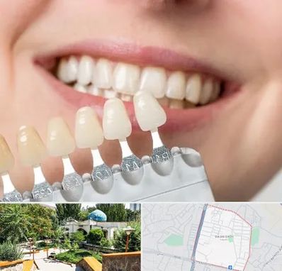 مرکز کامپوزیت دندان در باغمیشه تبریز