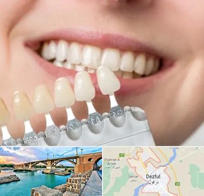مرکز کامپوزیت دندان در دزفول