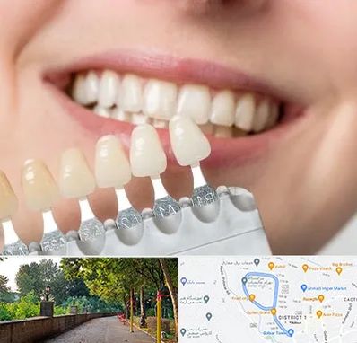 مرکز کامپوزیت دندان در فلکه گاز رشت