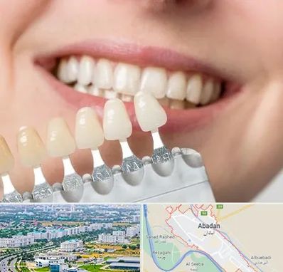 مرکز کامپوزیت دندان در آبادان