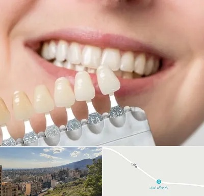 مرکز کامپوزیت دندان در بوکان تهران