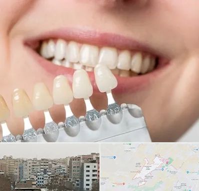 مرکز کامپوزیت دندان در محمد شهر کرج