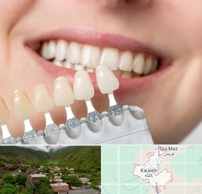 مرکز کامپوزیت دندان در کلاله