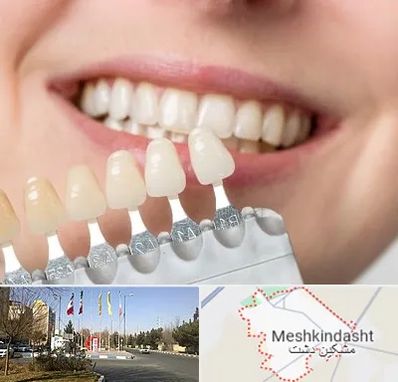 مرکز کامپوزیت دندان در مشکین دشت