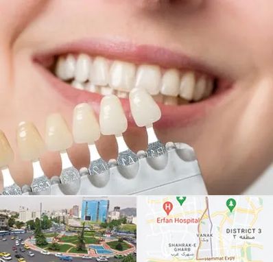 مرکز کامپوزیت دندان در ونک تهران