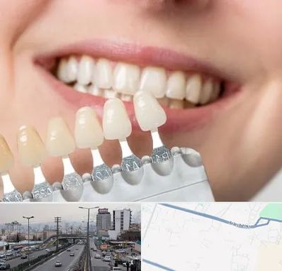 مرکز کامپوزیت دندان در بلوار ارتش