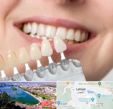 مرکز کامپوزیت دندان در لاهیجان