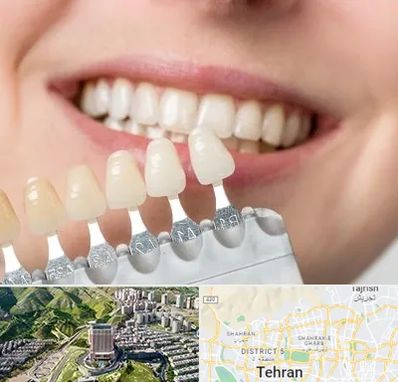 مرکز کامپوزیت دندان در شمال تهران