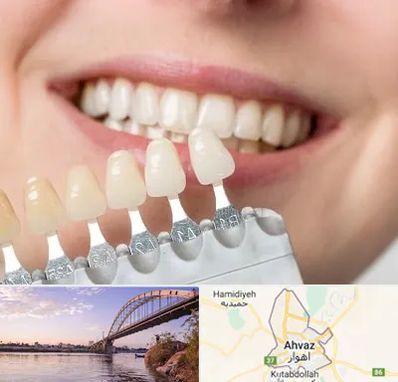 مرکز کامپوزیت دندان در اهواز