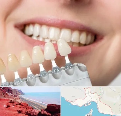 مرکز کامپوزیت دندان در هرمزگان