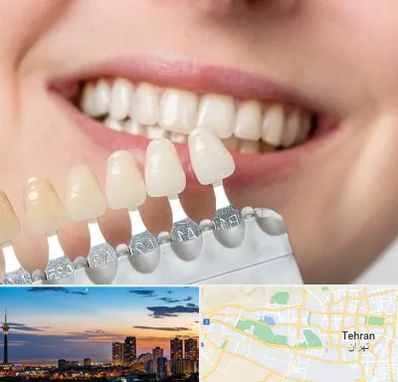 مرکز کامپوزیت دندان در غرب تهران