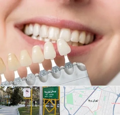 مرکز کامپوزیت دندان در تهران ویلا