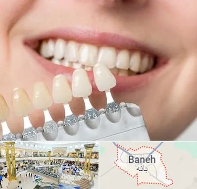 مرکز کامپوزیت دندان در بانه