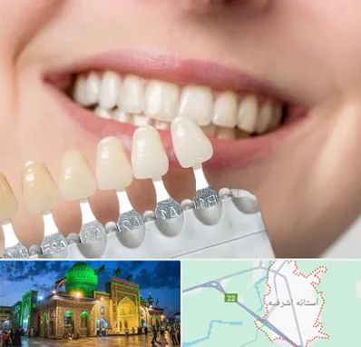 مرکز کامپوزیت دندان در آستانه اشرفیه