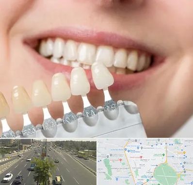 مرکز کامپوزیت دندان در منطقه 17 تهران