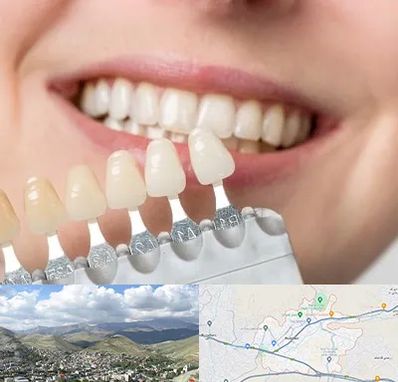 مرکز کامپوزیت دندان در رودهن