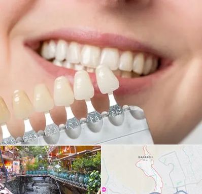 مرکز کامپوزیت دندان در درکه