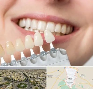 مرکز کامپوزیت دندان در قزوین