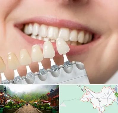 مرکز کامپوزیت دندان در فومن