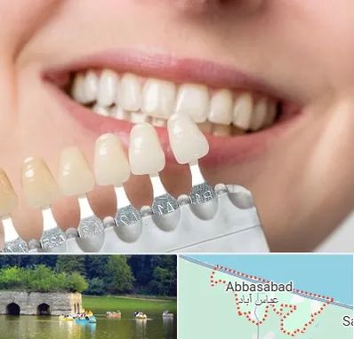 مرکز کامپوزیت دندان در عباس آباد