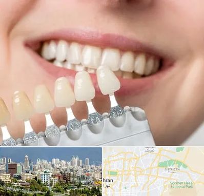 مرکز کامپوزیت دندان در شرق تهران