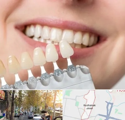 مرکز کامپوزیت دندان در کاشانک