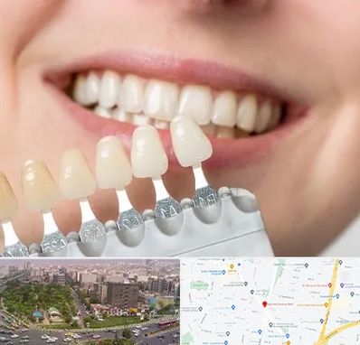 مرکز کامپوزیت دندان در آیت الله کاشانی