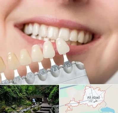 مرکز کامپوزیت دندان در علی آباد کتول