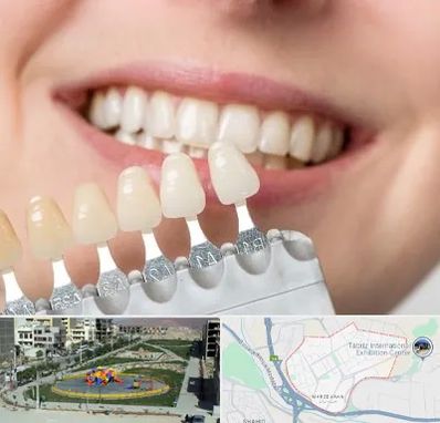 مرکز کامپوزیت دندان در مرزداران تبریز