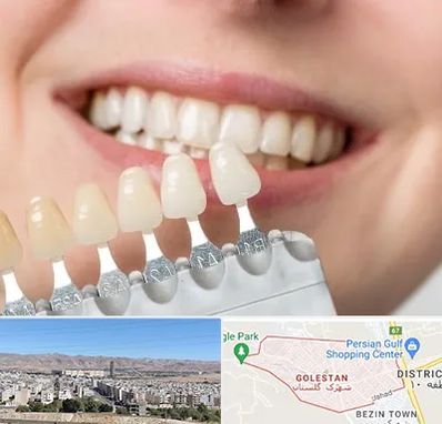 مرکز کامپوزیت دندان در شهرک گلستان شیراز